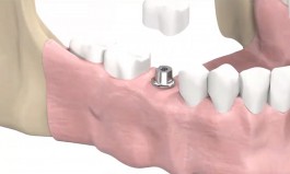 Имплантация зубов в Калининграде — где сделать безопасно?