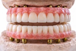 &laquo;Все на 4&raquo; и &laquo;Все на 6&raquo;: кому подходит быстрая имплантация и где скрываются риски